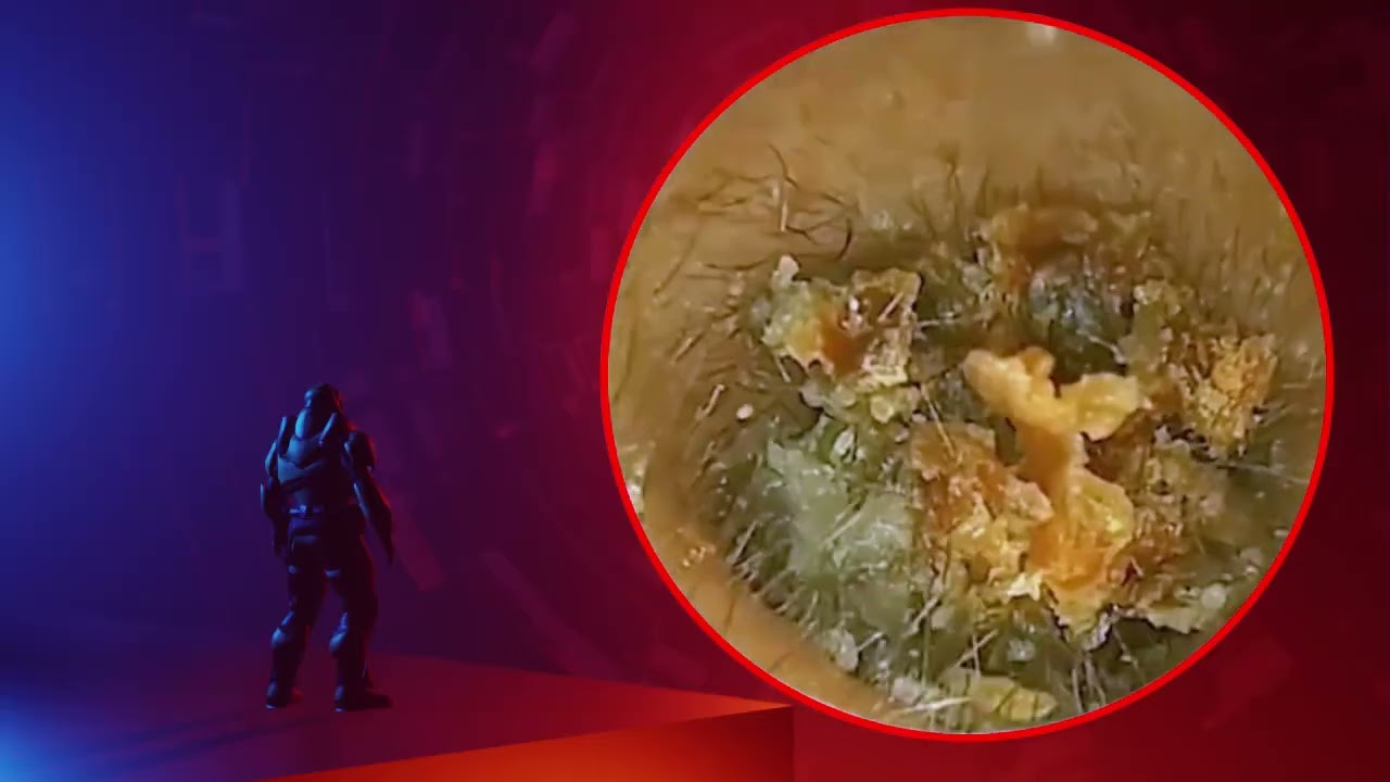 The Truth About earwax Will Shock You. How to remove earwax from ear, earwax extractions