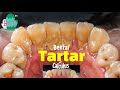 Bye bye Dental Calculus Scaling Tartar Removal