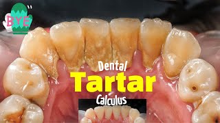 Bye bye Dental Calculus Scaling Tartar Removal