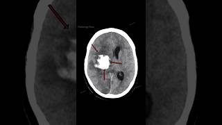 Patient With Headache, Vomiting, Confusion, & Difficulty Speaking. Whats Your Diagnosis?
