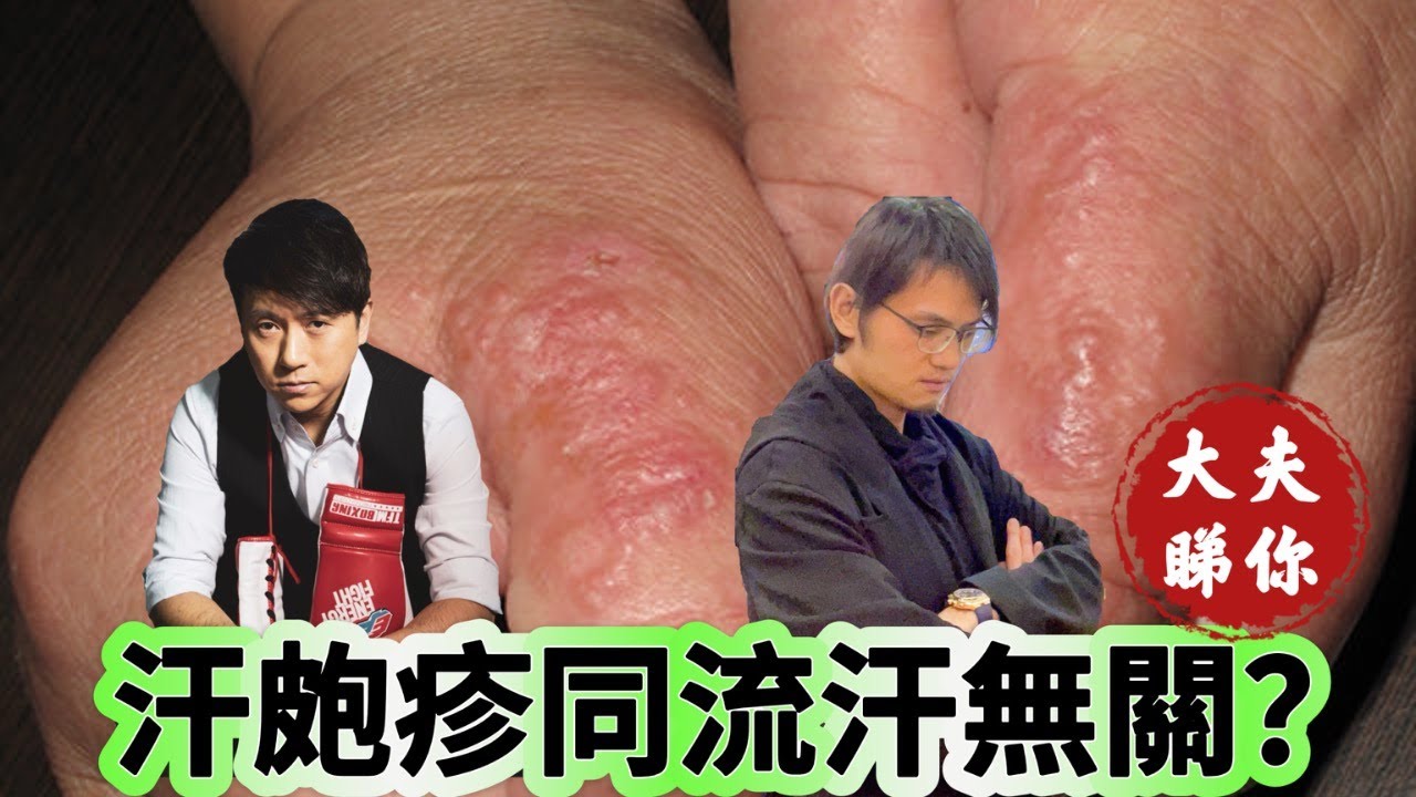 大夫睇你：汗皰疹同流汗無關？