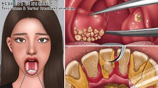 ASMR 오랫동안 없어지지 않는 입냄새 퇴치! 편도결석 치료 & 치석 제거 애니메이션 | 백태 제거 | Tartar & Tonsil Stone Removal Animation screenshot 1