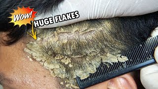 Huge Dandruff Flakes Removing and Picking #635