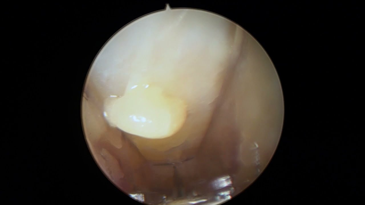 Lawrence E. Weiss, MD - Endoscopic Carpal Tunnel Release