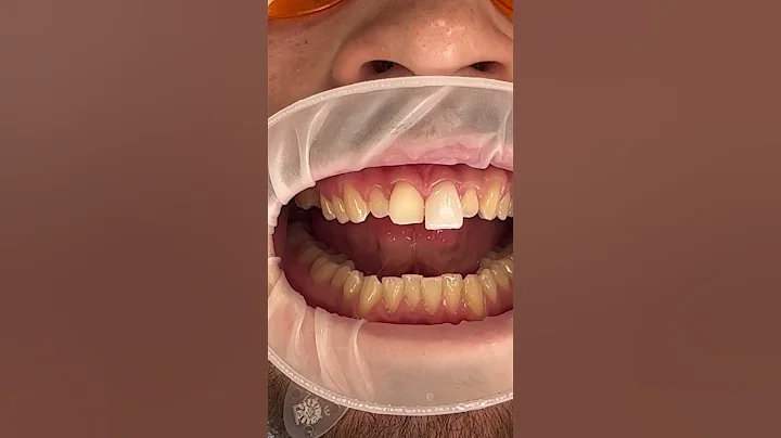 Veneers Process