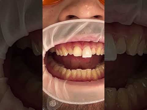 Video: Apakah yang dimaksudkan dengan buck tooth?