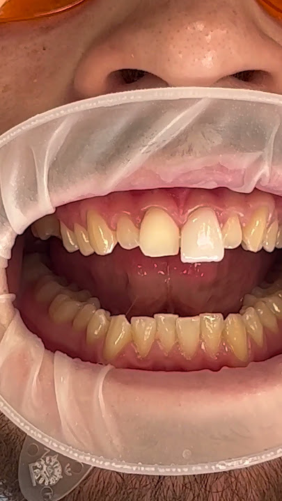 Veneers Process