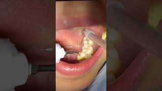 ازالة جير الأسنان dentist dr_abdullah_sultan_dentist dental anesthesia 소아치과 orthodontics