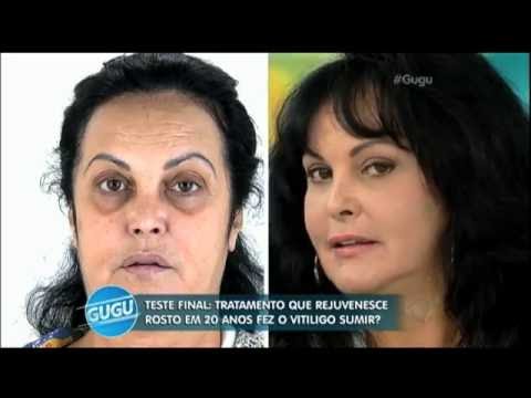 Vídeo: A Esteticista Nomeou Os Procedimentos Que Vão Ajudar A 