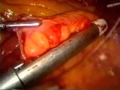 Gunshot Wound to the Abdomen: Laparoscopic Exploration and Repair of Small Bowel Injury