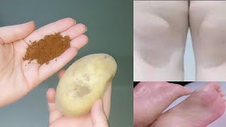 القهوة والبطاطس 🥔 لن تصدق النتائج أقسم بالله ندمت إني ماعرفتها من زمان جربيها بنفسك