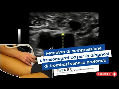 Manovra di compressione ultrasonografica per la diagnosi di trombosi venosa profonda (CUS)