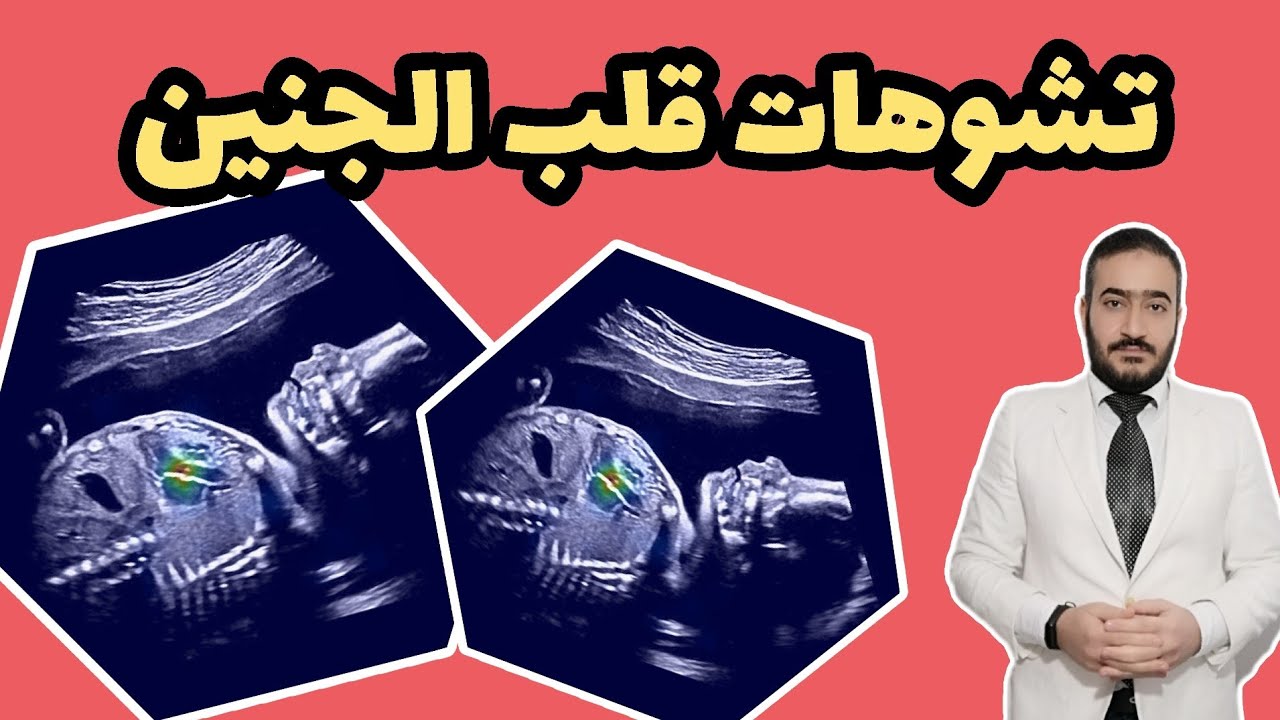ما أسباب تشوهات قلب الجنين ؟ وكيف تحافظ الحامل على قلب الجنين من العوامل البيئية؟