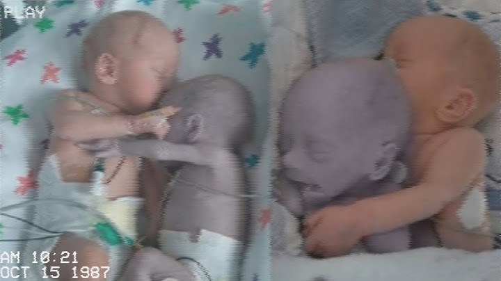 Krankenschwester legt gesundes Baby neben sterbenden Zwilling. Unfassbar was dann geschah