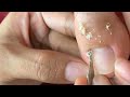 HOW TO CUT THICK TOENAILS - Toenail Cleaning Satisfying #208