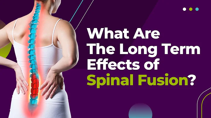 What Are The Long Term Effects of Spinal Fusion?