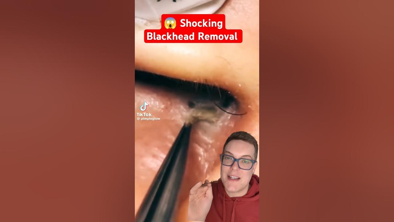Shocking BLACKHEAD REMOVAL Blackhead Inside Nose!! shorts YouTube