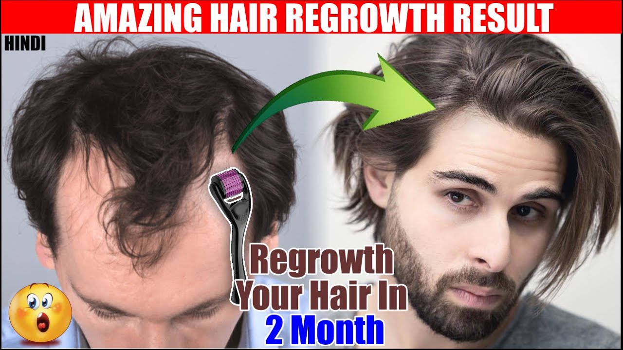 Fix Receding Hairline using Derma Roller Derma Roller for Hair Growth