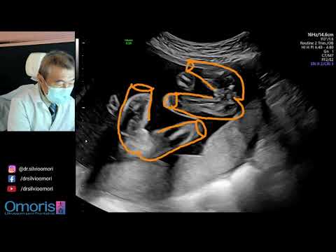 Ultrasonda sürpriz! Hamilelik 21 hafta.
