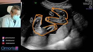 Ultrasonda sürpriz! Hamilelik 21 hafta.