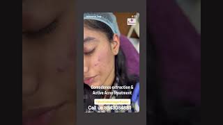 Comodones Extraction with Active Acne  Treatment