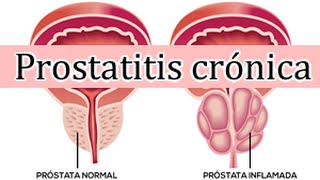 prostatitis cronica abacteriana tratamiento natural)