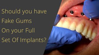Fake Gums on your Full Set of Dental Implants? (or all on 4)