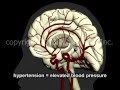 What Is A Stroke? - Narration and Animation by Dr. Cal Shipley, M.D.