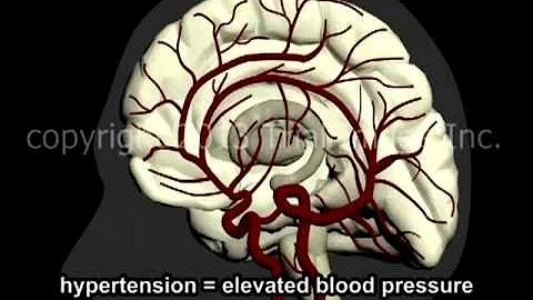 What Is A Stroke? - Narration and Animation by Dr. Cal Shipley, M.D.
