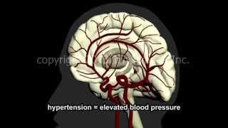 What Is A Stroke?  Narration and Animation by Dr. Cal Shipley, M.D.