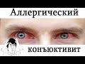 [ Dr. Ozz ] Аллергический конъюнктивит. Все что нужно знать. [ Помощь больному ]