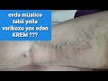 skleroterapiya kopuk tedavisi kapilyar varikoz ucun krem gel evde müalice turkecare tebii yolla otla