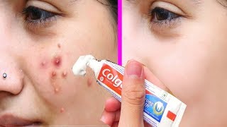 Colgate सिर्फ 1 मिनिट में आपके चेहरे के Pimples - Acne को गायब कर देगा//Remove Pimples From Face