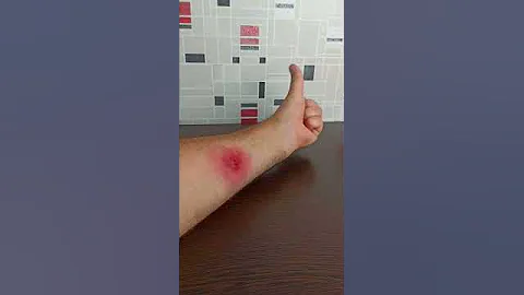 Как избавиться от укуса ГИГАНТСКОЙ СКОЛОПЕНДРЫ. Последствия укуса.