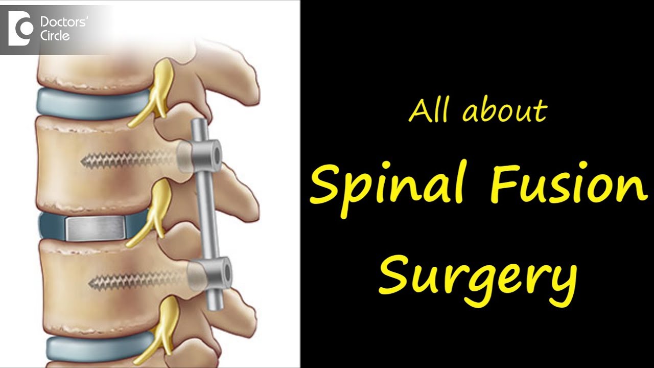 How Is A Spinal Fusion Surgery Performed Dr Kodlady Surendra Shetty 