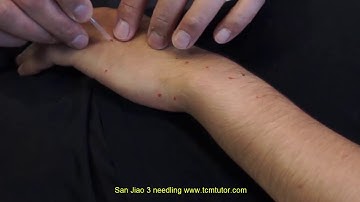 How to needle San Jiao 3 Zhongzhu (Central Islet)