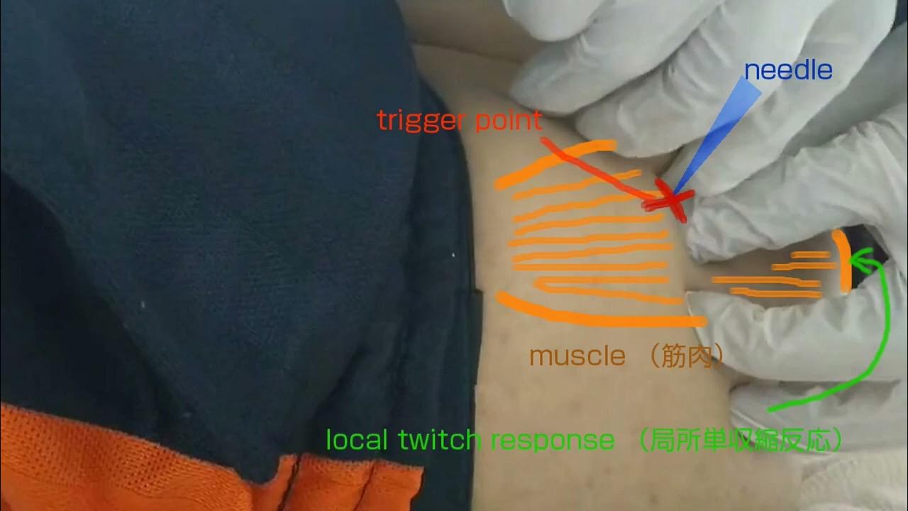 Trigger point dry needling local twitch response trp dn ltr 