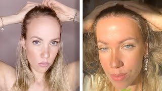 Woman, Who Hated Large Forehead, Undergoes Impressive Hair Transplant
