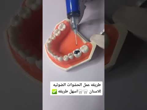 طريقه عمل حشوات الاسنان