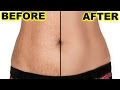 How To Prevent & Remove Stretch Marks at Home | ShrutiArjunAnand