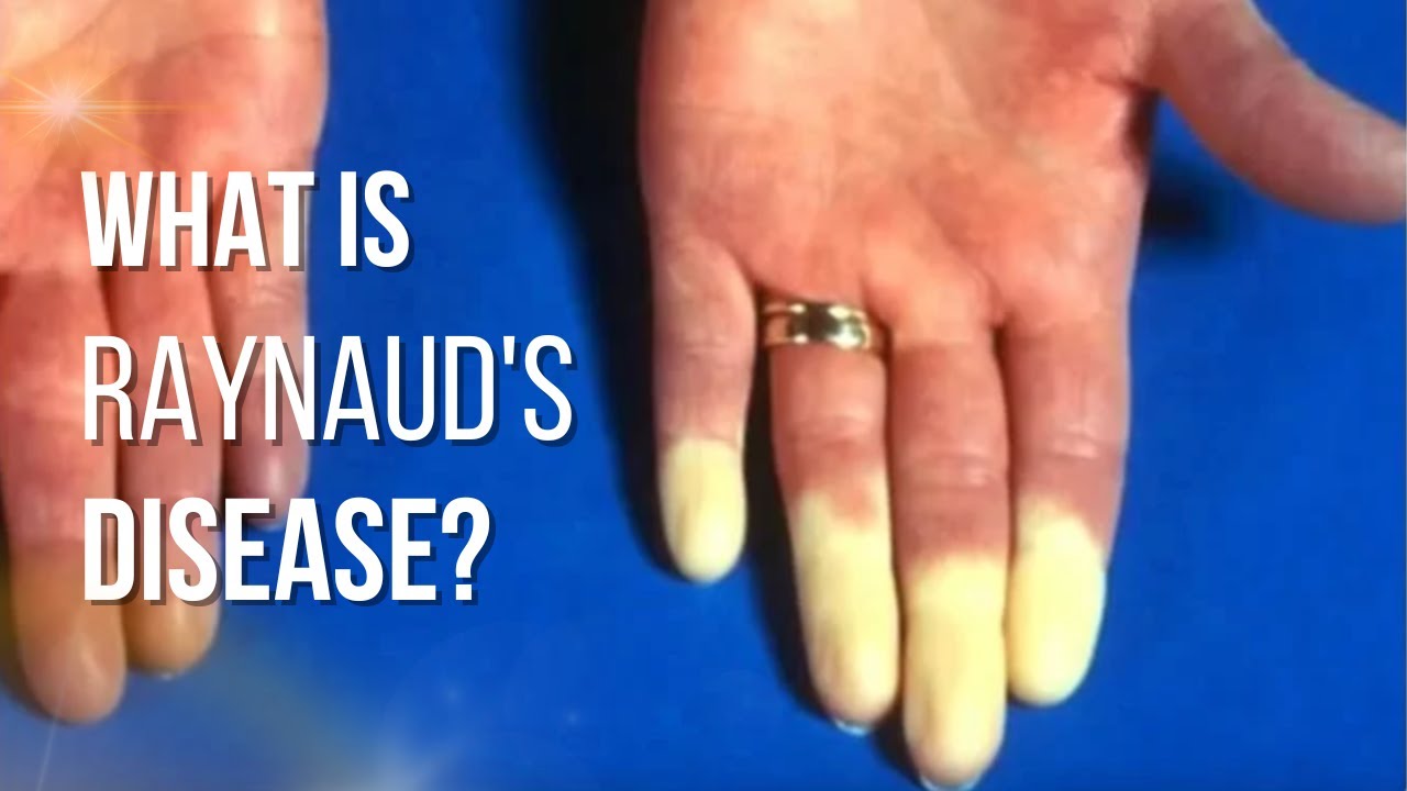 What Is Raynaud's Disease? [Raynaud's Syndrome] All The Facts - YouTube