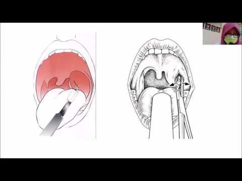 Video: Adakah saya perlu pergi ke er untuk abses peritonsil?