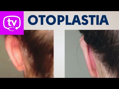 Otoplastia, la solución para corregir las orejas de soplillo