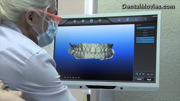 iTero - Orthodontic Scanning
