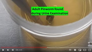 Adult Pinworm found during Urine Examination Content