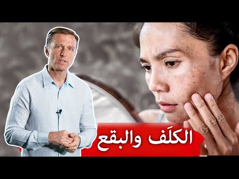 فيديو الكلف بقع الجلد الداكنة ٣ أسباب ونصائح, طب و صحة الكلف بقع الجلد الداكنة ٣ أسباب ونصائح