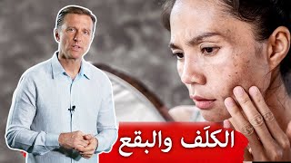 الكلف بقع الجلد الداكنة | ٣ أسباب ونصائح