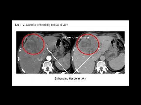 3. LI-RADS: Overview of CT/MR algorithm and major features - Part 1. By Dr. Victoria Chernyak.