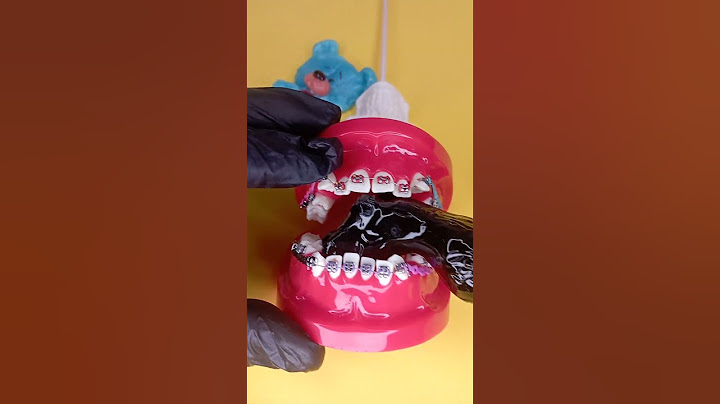 LOLLIPOP vs Braces! PIRULETA vs Brackets! ¿Qué alimentos comer con brackets?