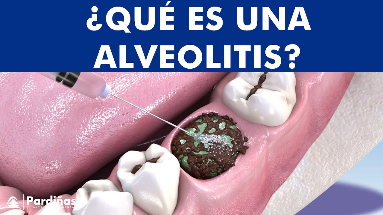 Alveolitis Dental Infección Tras Extracción De Muela Causas Y Tratamiento © Youtube 